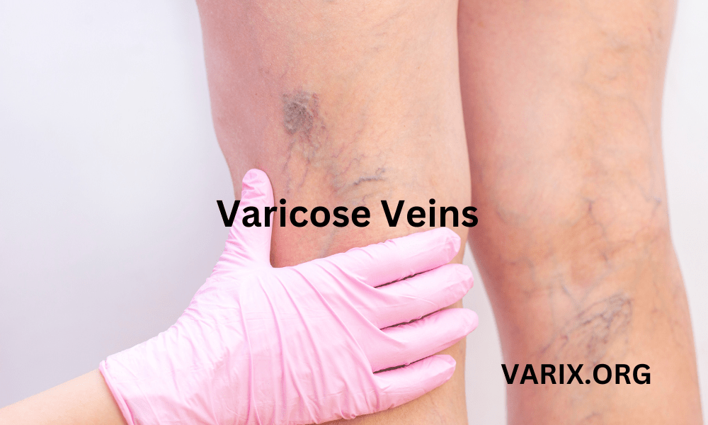 Defeat Varicose Veins: Causes, Symptoms & Treatment Options